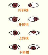 看看兒童斜視眼病怎么預(yù)防？
